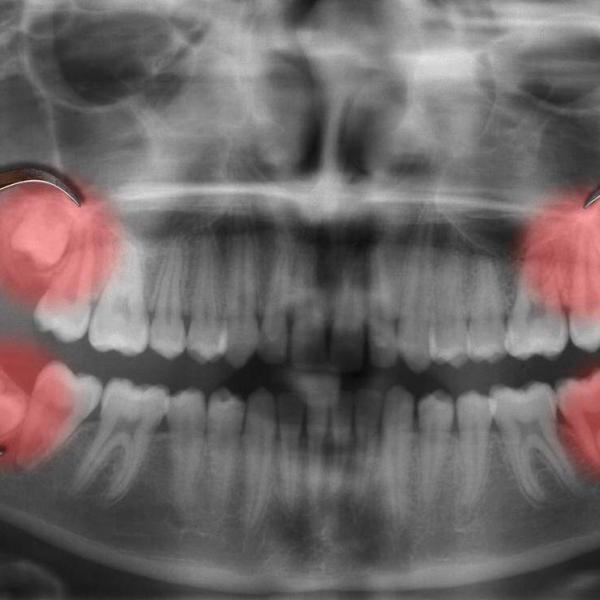 wisdom teeth x-ray