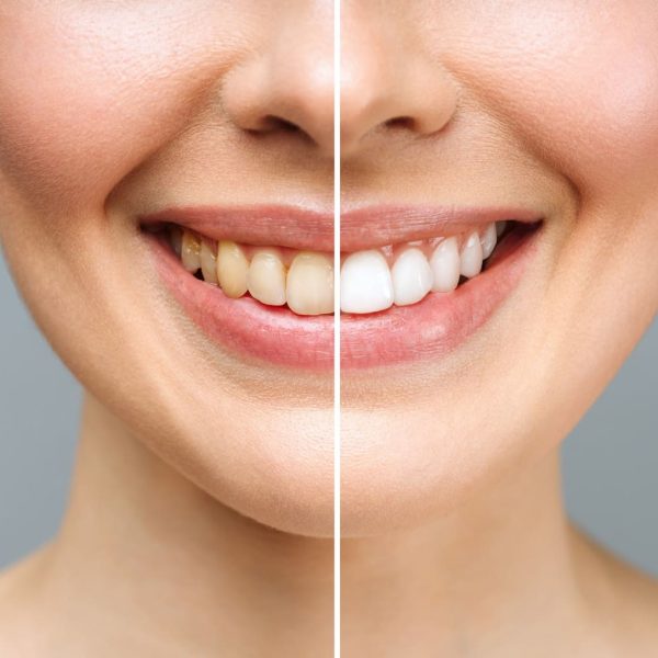 Facts about Teeth Whitening