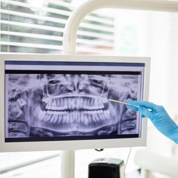 Are Dental X-Rays Safe