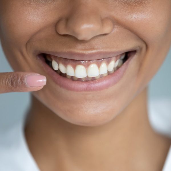Teeth Whitening Dentist St. Louis