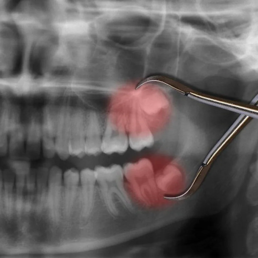 wisdom-teeth-removal-st-louis-1024x539