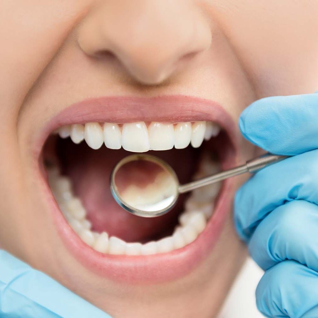 Dental Filling Process